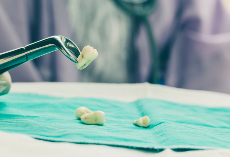 Entenda como o dente do siso deitado pode afetar a sua saúde bucal e como lidar com o quadro