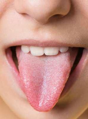 A língua branca em crianças nem sempre é sinônimo de má higiene bucal. Entenda!