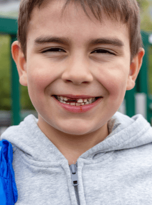 Cárie no dente da frente pode ser resolvida com tratamento de canal?