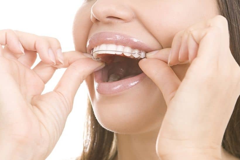 A barra de contenção ajuda a manter os dentes na posição correta após o tratamento ortodôntico