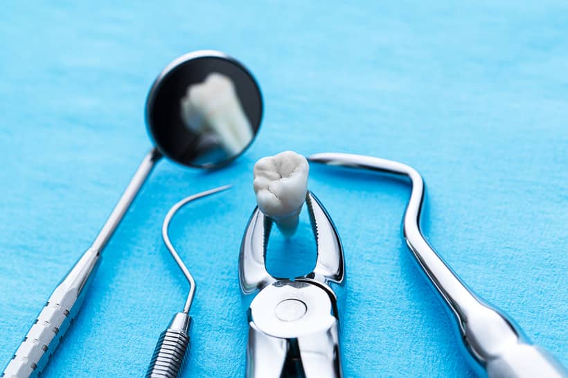 A extração dos sisos é indicada quando há a presença de dor e desalinhamento dos dentes vizinhos