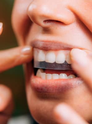 Fita de clareamento dental é melhor do que a moldeira?