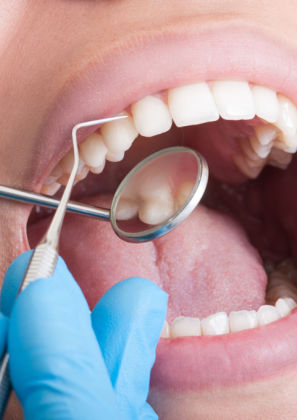 Tártaro: algum produto consegue removê-lo do dente?