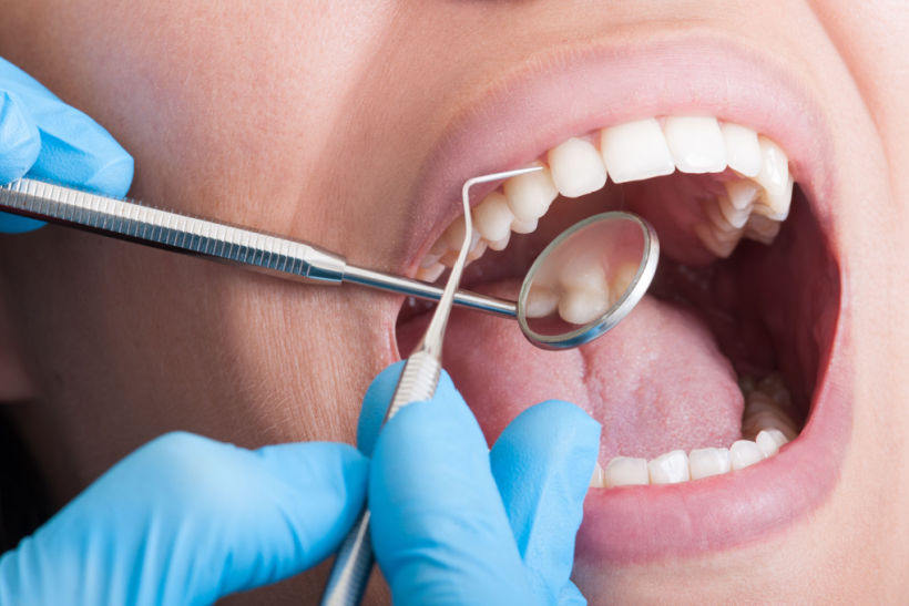 O tártaro precisa ser removido o mais rápido possível. A única maneira é com ajuda de um dentista profisional.