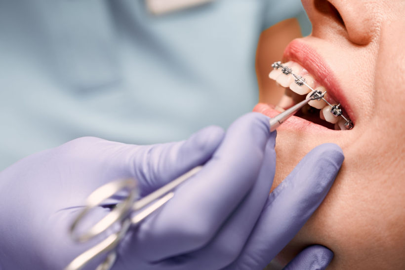 Quem tem implante dentário pode sim usar aparelho ortodôntico, mas desde que a prótese esteja bem posicionada 