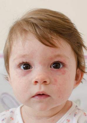 Herpes em bebês: como identificar e tratar corretamente