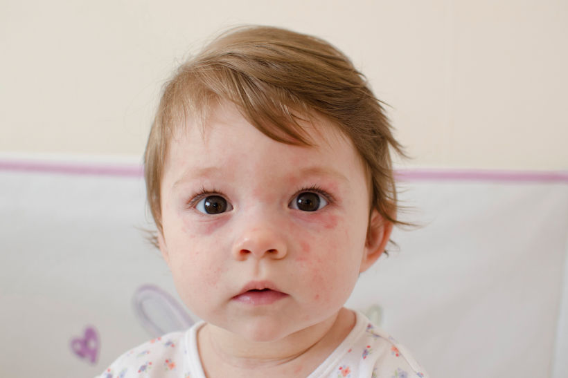 O herpes em bebê pode causar sintomas mais intensos, como lesões na boca e nas bochechas, febre e inchaços no rosto 
