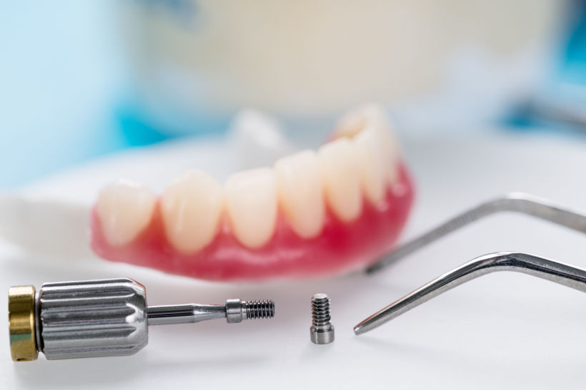 A prótese overdenture consegue substituir vários dentes de uma vez e oferece melhor fixação