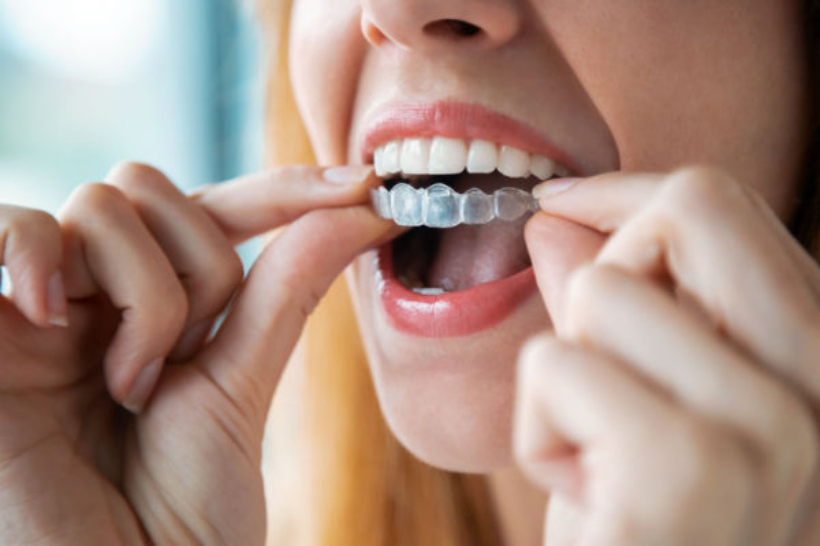 Ao perder o alinhador invisível, o paciente deve utilizar a placa dental anterior de forma temporária e procurar o dentista responsável pelo tratamento