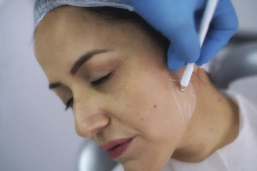 Uma profissional de saúde aplica uma injeção de toxina botulinica no rosto de uma mulher que está com os olhos fechados e tem marcações na pele, indicando um tratamento médico.